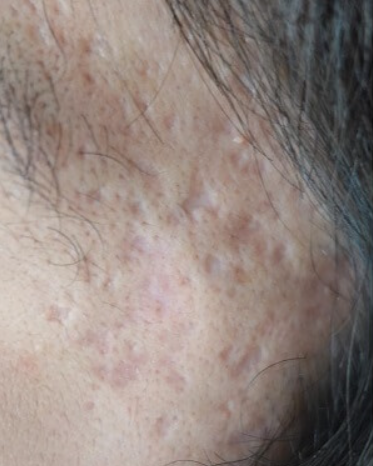 ニキビ跡とは？