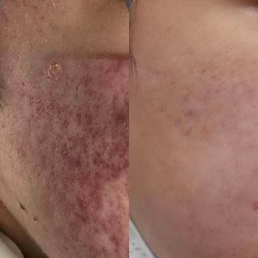 右頬にできたニキビ跡の赤みにVビームを使った症例