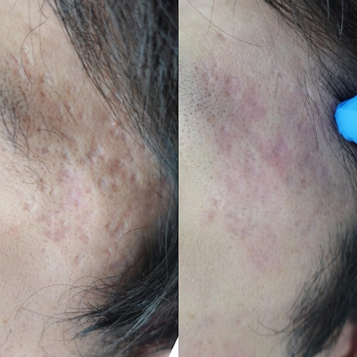 左頬にできた深いニキビ跡の凹みにサブシジョンを使った症例