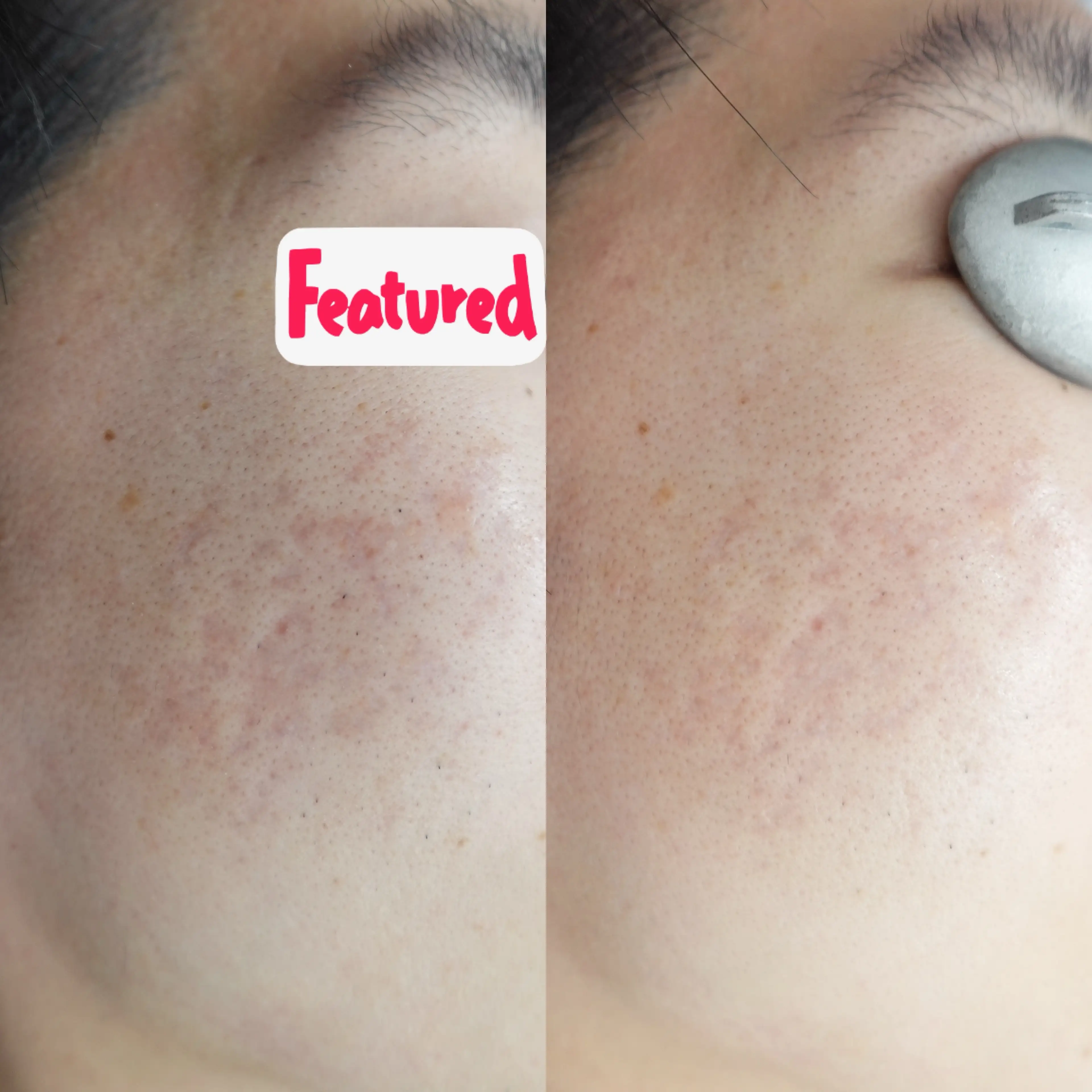 ダーマV症例画像