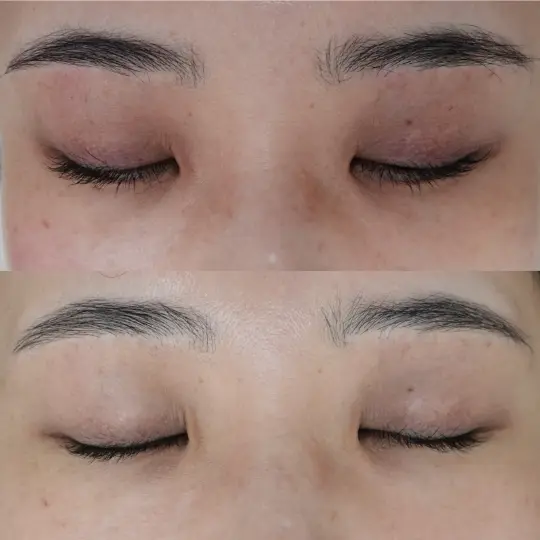 ジュベルックシャイン症例