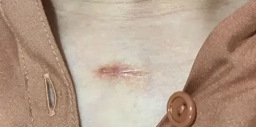 ケロイド・肥厚性瘢痕とは？