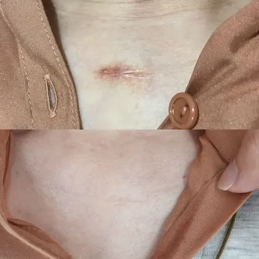 Vビームによりケロイドの赤みにアプローチした症例