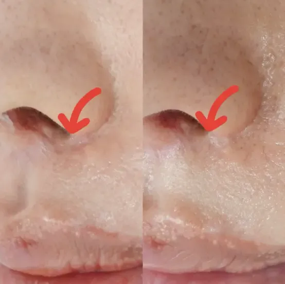 オペ後の傷跡に対する当院での症例