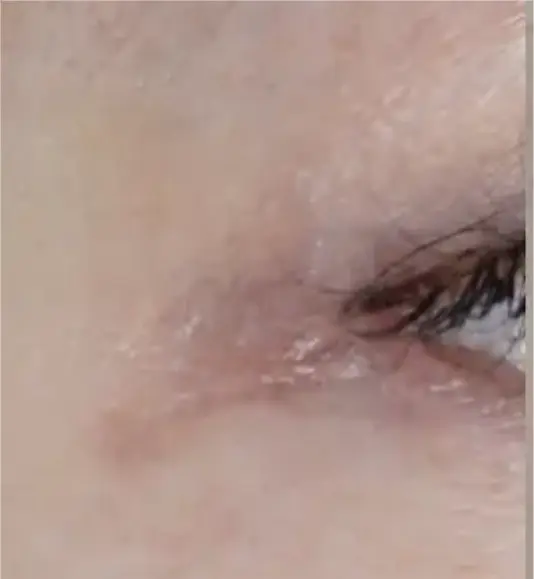 平坦な傷跡の原因とは