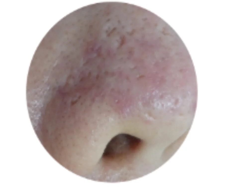 アイスピック型