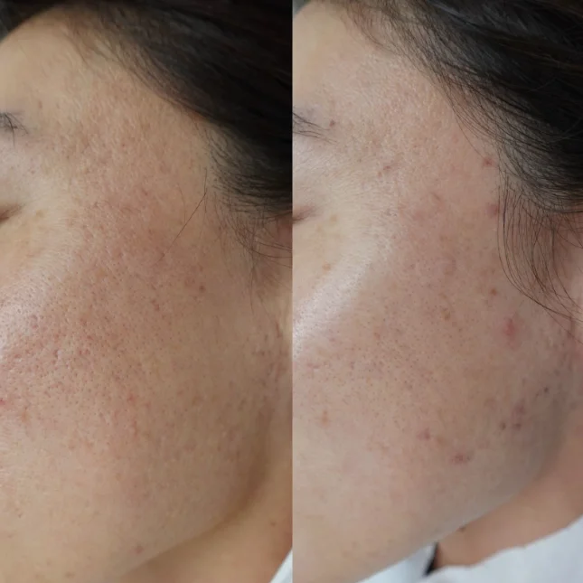 ニキビ跡のへこみに対する当院での症例3 写真2